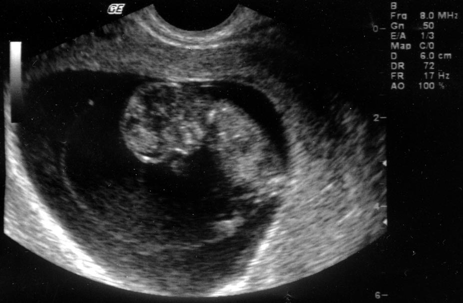 11 неделя шевеления. 10 Недель беременности фото плода на УЗИ. УЗИ на 10 акушерской неделе беременности. Снимок УЗИ на 10 неделе беременности. УЗИ плода на 10 неделе беременности.